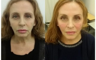 Un esempio di un viso prima e dopo trattato con il Lifting non Chirurgico